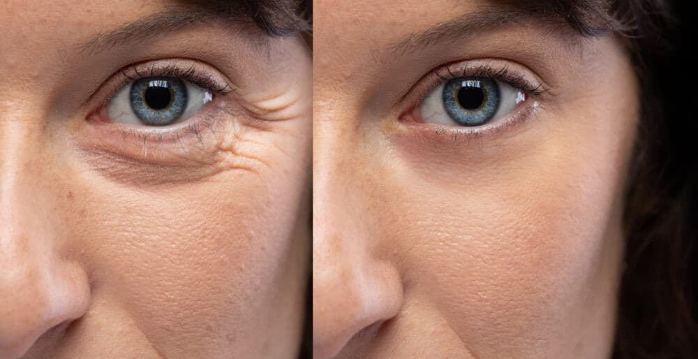 How Will My Eyelids Look Different As I Age Ary Krau Md