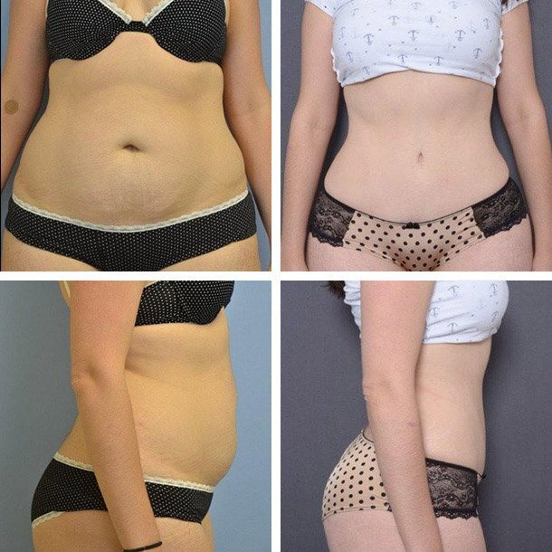 Tummy Tuck Before & After - Ary Krau MD